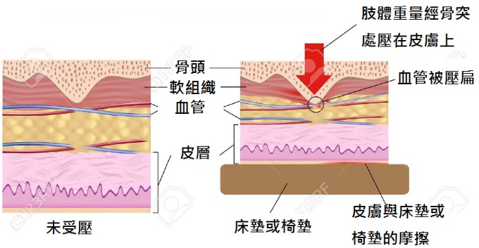 正確認識長輩的壓瘡治療與預防 - 顧名思醫