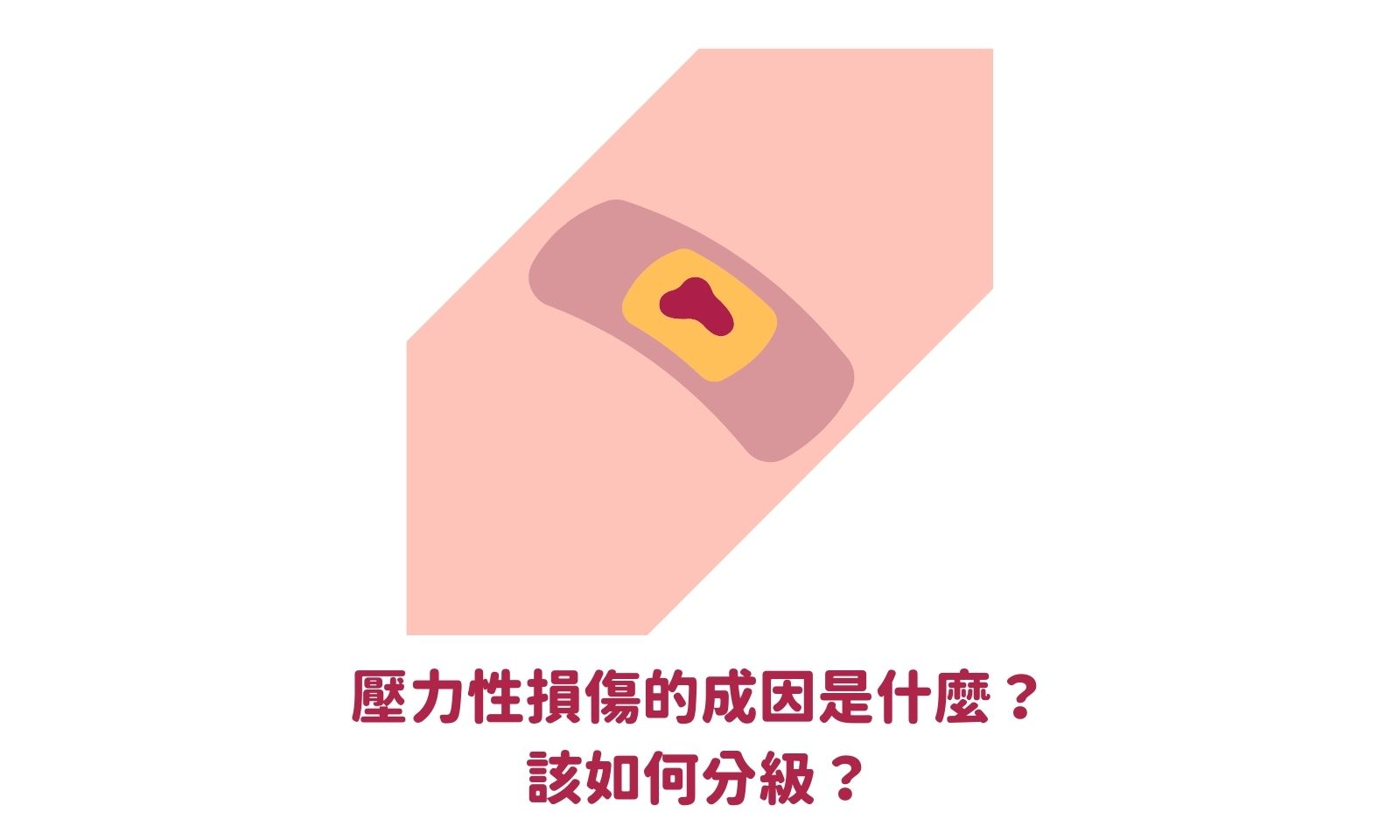 壓力性損傷的成因是什麼? 該如何分級? - 顧名思醫